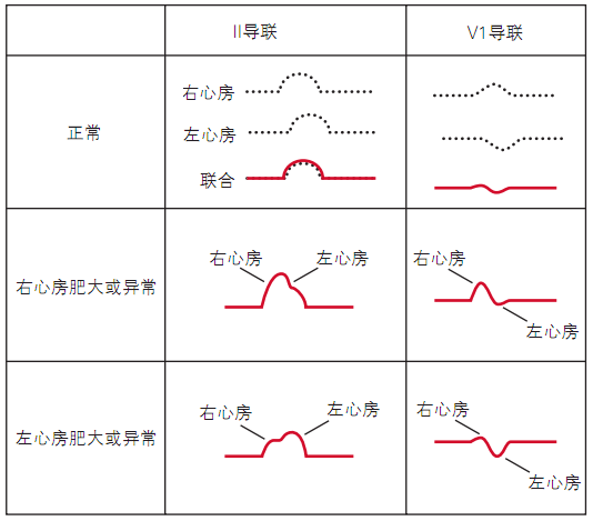 缺血,梗死,肥厚……常见心肌疾患的心电图表现