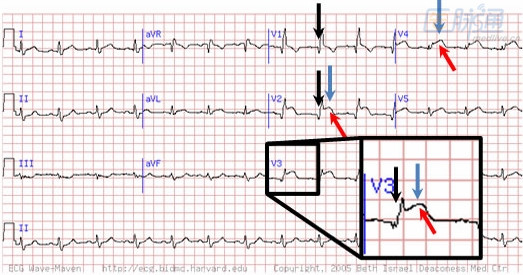 心肌梗死的不典型心电图:18个图例,练就火眼金睛