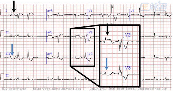 图18【例14】图19心电图示下壁心梗及肢导联低电压.