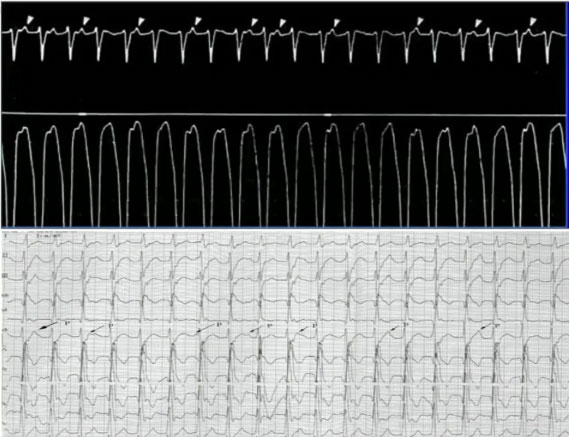 鉴别诊断的2个技巧  室速发作时,心电图可表现为:①房室分离(图1);②
