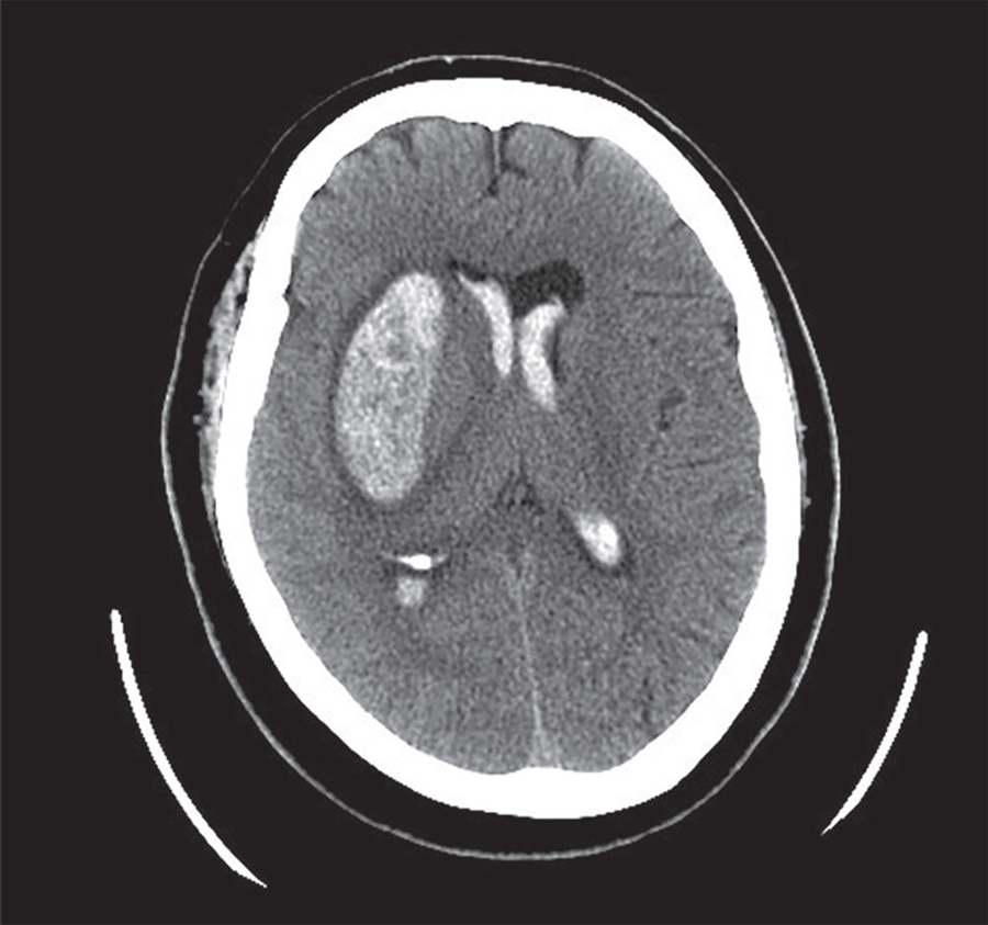 图1  头部ct平扫显示右侧壳核和脑室内出血