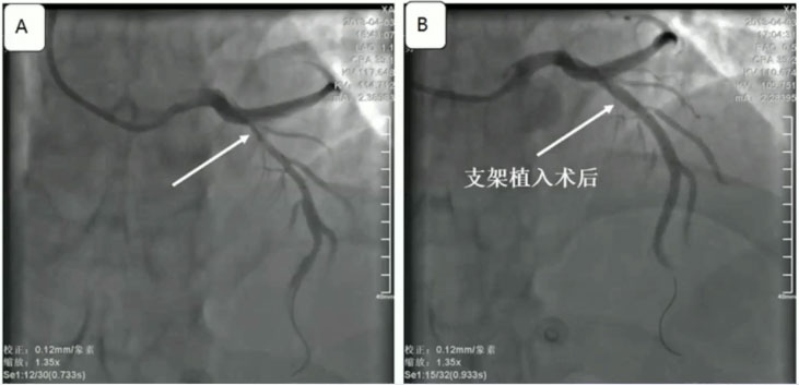 图4 急诊冠脉造影及pci1982年荷兰心脏病学家wellens等发现,145名uap