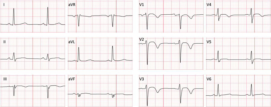 心电图示v1~v4导联t波倒置,Ⅰ,avl,Ⅲ,avf导联st段恢复至基线水平
