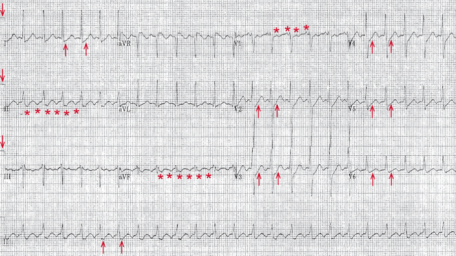 心电图b分析:心房扑动伴1:1房室传导阻滞
