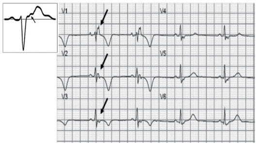 一文纵览:8种心肌病的心电图表现  心电图特征: ①epsilon波:epsilon