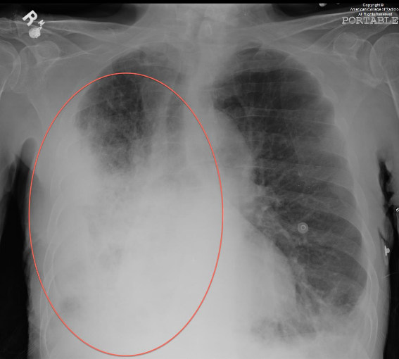 大量胸腔积液 答案:a b d 非典型肺炎通常在胸部x线片上可见,为双侧