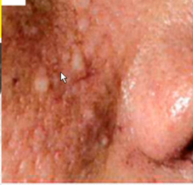 bhd综合征患者的面部鼻唇部图片:多发圆形皮疹(纤维毛囊瘤)