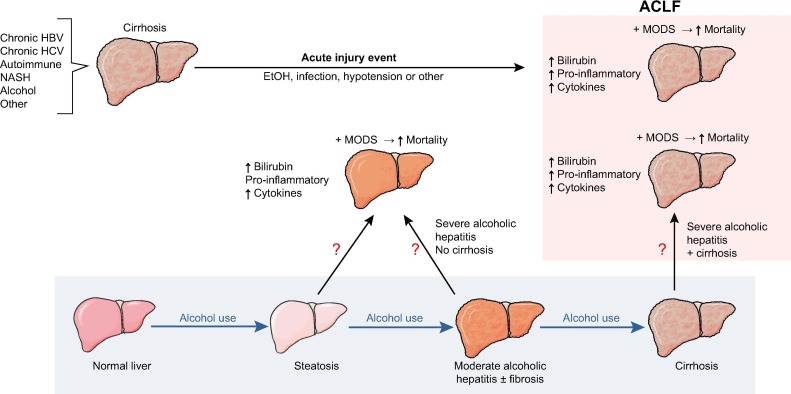 j hepatol:严重酒精性肝炎可表现为慢加急性肝衰竭