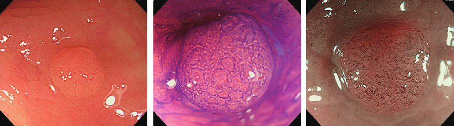 管状腺瘤(tubular adenoma) 大多数结肠腺瘤为管状腺瘤,散在生长.