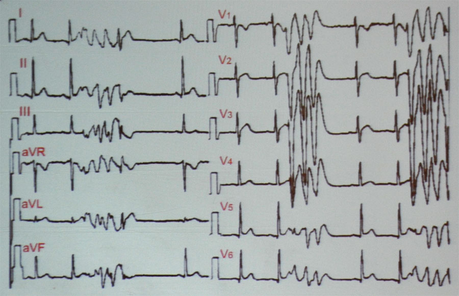 恶性心律失常的10种警示性心电图  特发性室颤心电图的形态一致: 每次