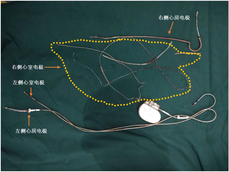 图4 拔除术后脉冲发生器及电极导线多体位透视可见右室心尖部电极头