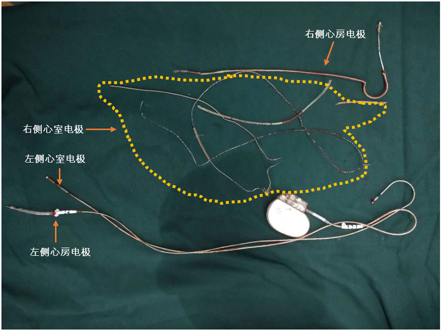 狭路相逢起搏器与乳腺癌同侧如何处理